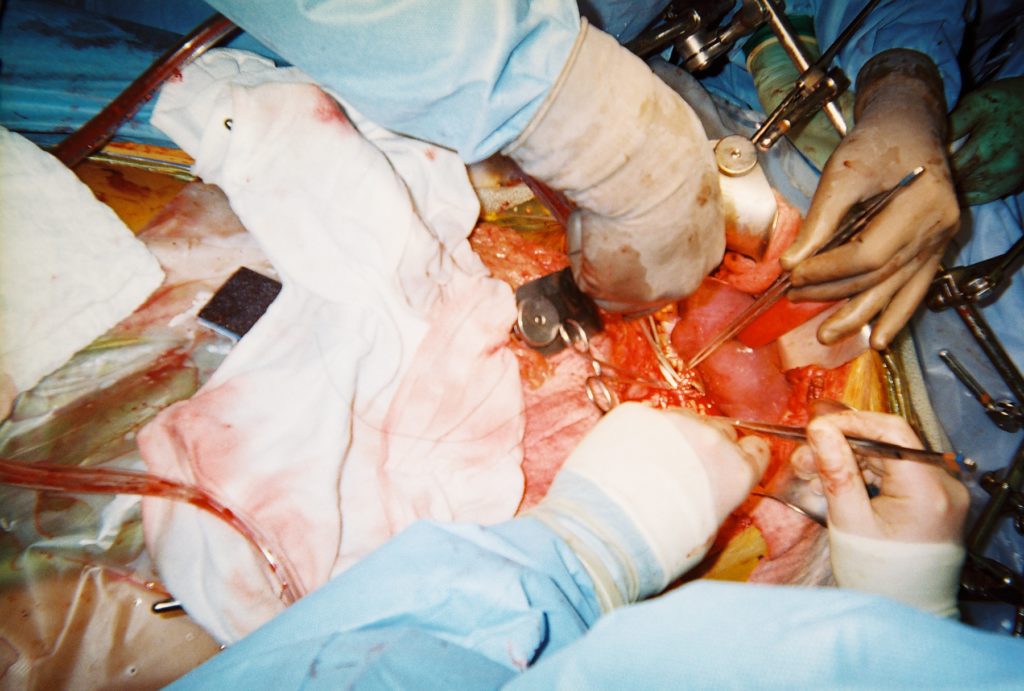 Liver Transplant surgery