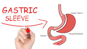 Considering Gastric Plication Revision? Get to Know the Options